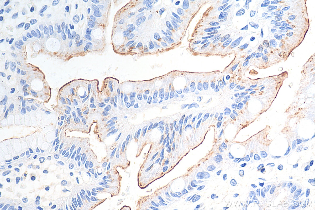 Immunohistochemistry (IHC) staining of human stomach cancer tissue using MUC13 Polyclonal antibody (29832-1-AP)