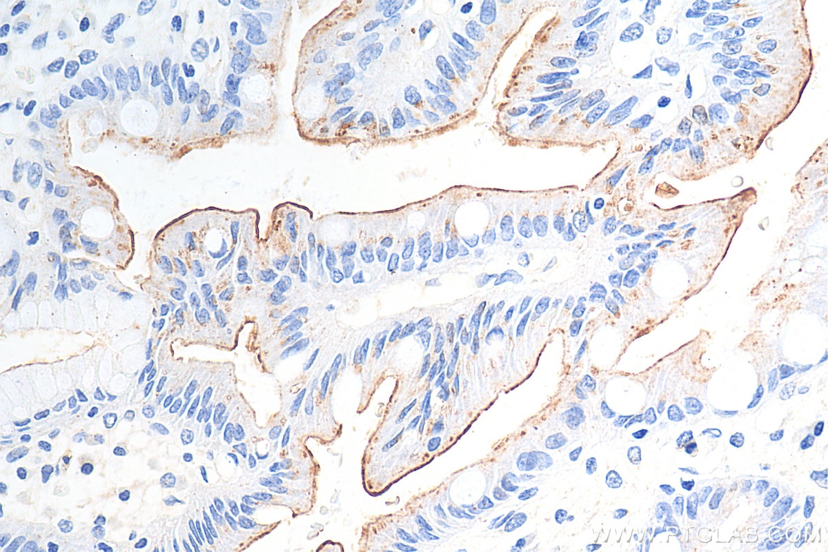 Immunohistochemistry (IHC) staining of human stomach cancer tissue using MUC13 Polyclonal antibody (29832-1-AP)
