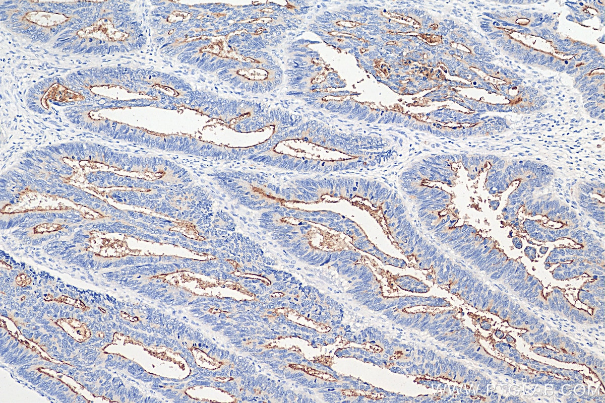 Immunohistochemistry (IHC) staining of human colon cancer tissue using MUC13 Polyclonal antibody (29832-1-AP)