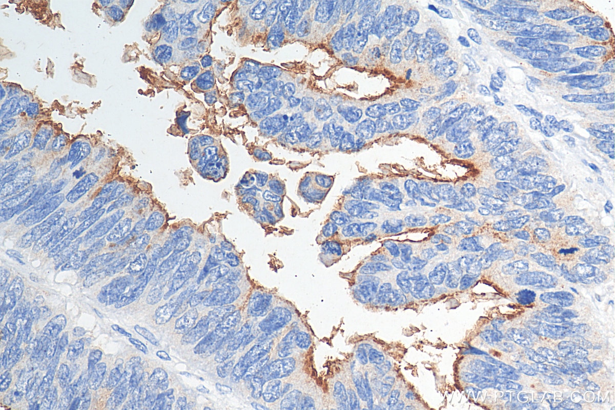 Immunohistochemistry (IHC) staining of human colon cancer tissue using MUC13 Polyclonal antibody (29832-1-AP)