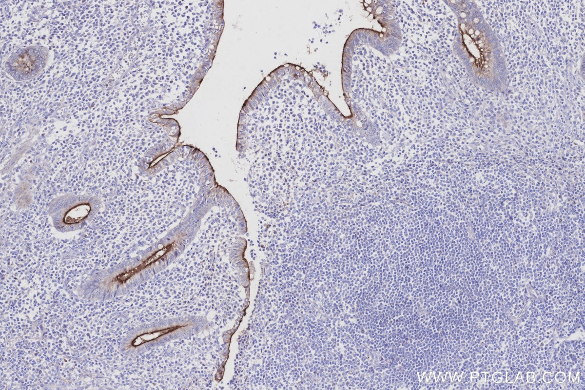 IHC staining of human appendicitis using 55487-1-AP Immunohistochemistry (IHC) staining of human appendicitis tissue using MUC13 Polyclonal antibody (55487-1-AP)