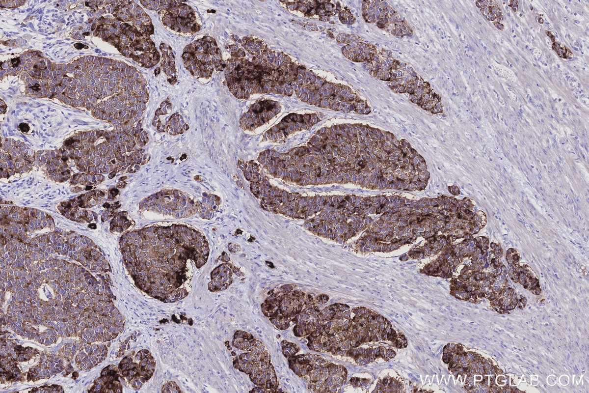 IHC staining of human stomach cancer using 55487-1-AP Immunohistochemistry (IHC) staining of human stomach cancer tissue using MUC13 Polyclonal antibody (55487-1-AP)
