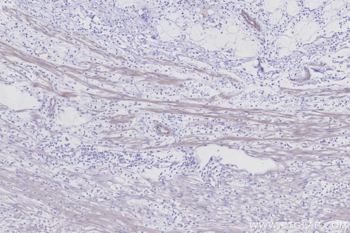 IHC staining of human appendicitis using 55487-1-AP Immunohistochemistry (IHC) staining of human appendicitis tissue using MUC13 Polyclonal antibody (55487-1-AP)