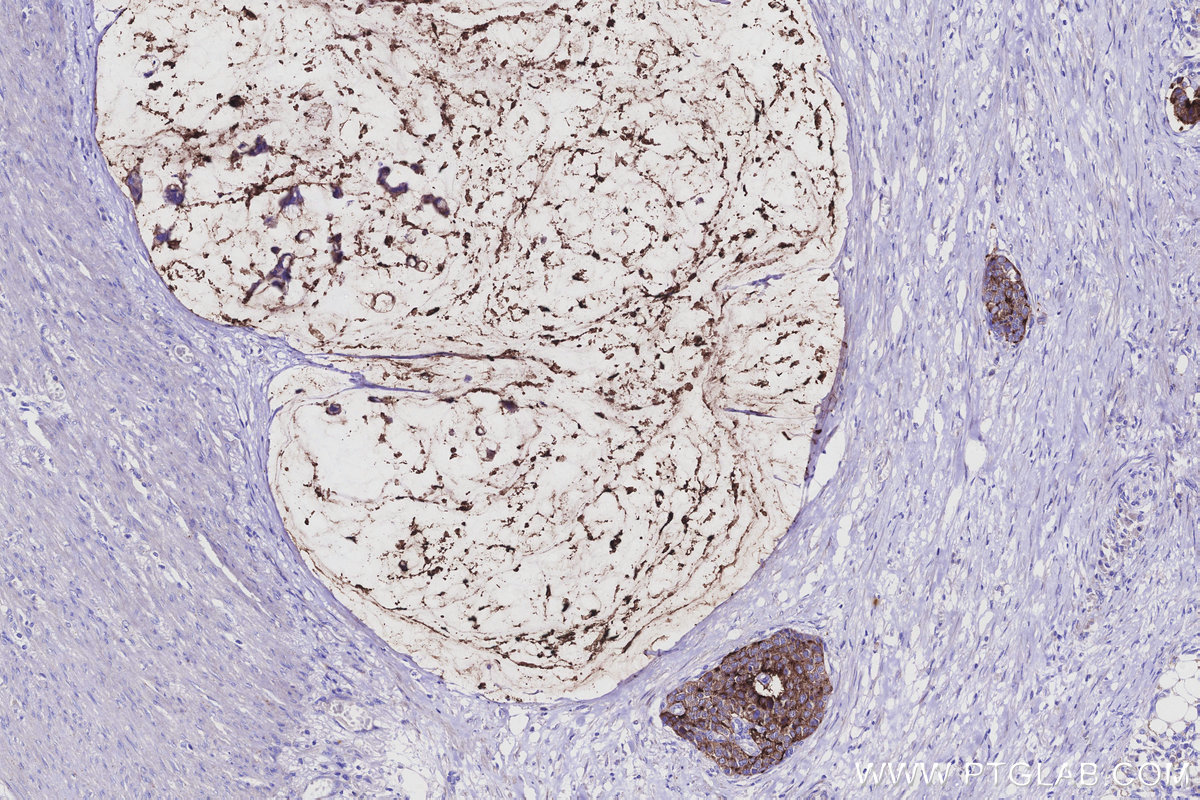 IHC staining of human stomach cancer using 55487-1-AP Immunohistochemistry (IHC) staining of human stomach cancer tissue using MUC13 Polyclonal antibody (55487-1-AP)