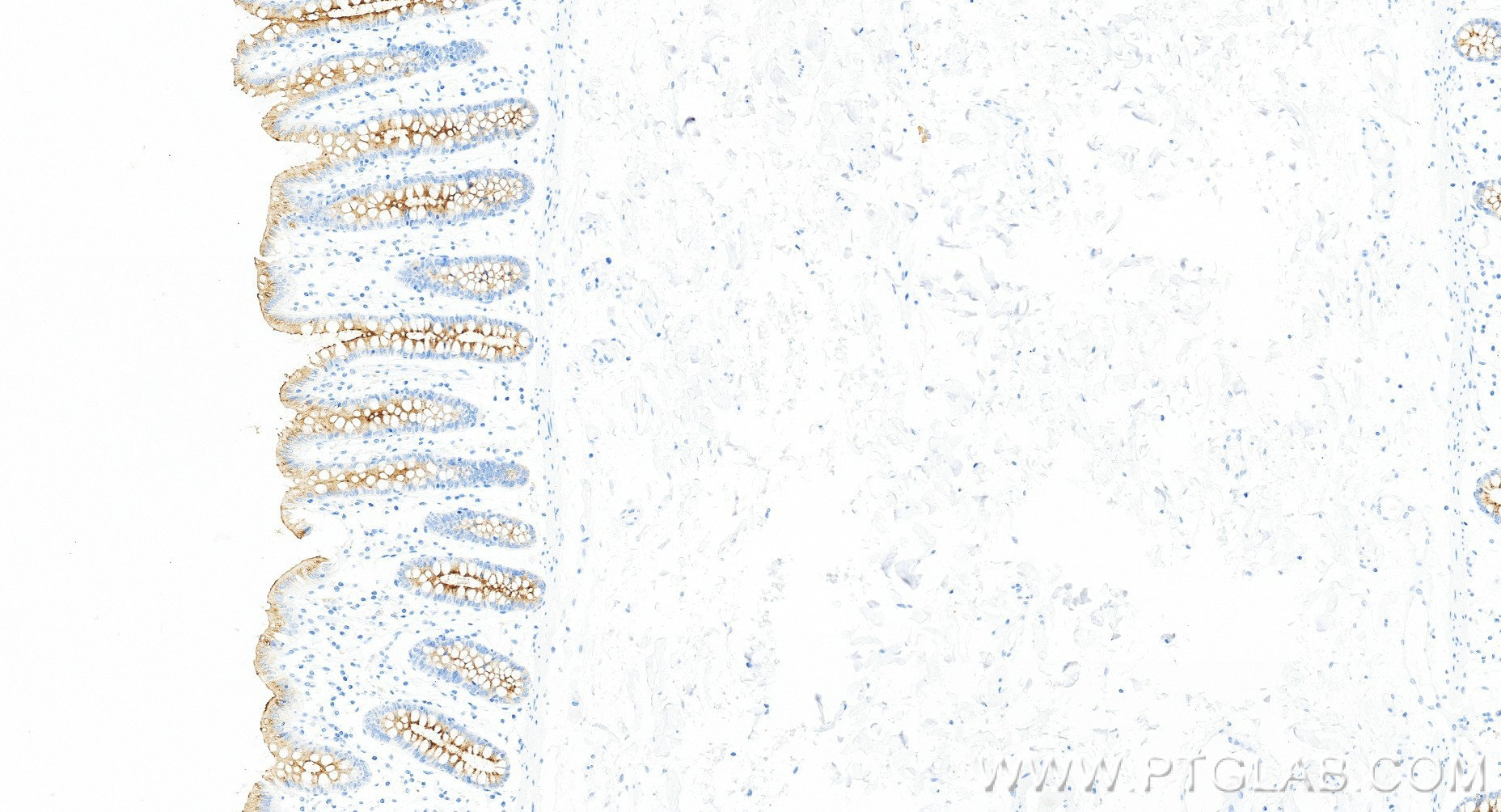 Immunohistochemical analysis of paraffin-embedded human colon tissue slide using 98683-1-RR (MUC13 antibody) at dilution of 1:1000 (under 20x lens). Heat mediated antigen retrieval with Tris-EDTA buffer (pH 9.0). Immunohistochemistry (IHC) staining of human colon tissue using Anti-Human MUC13 Rabbit Recombinant Antibody (98683-1-RR)