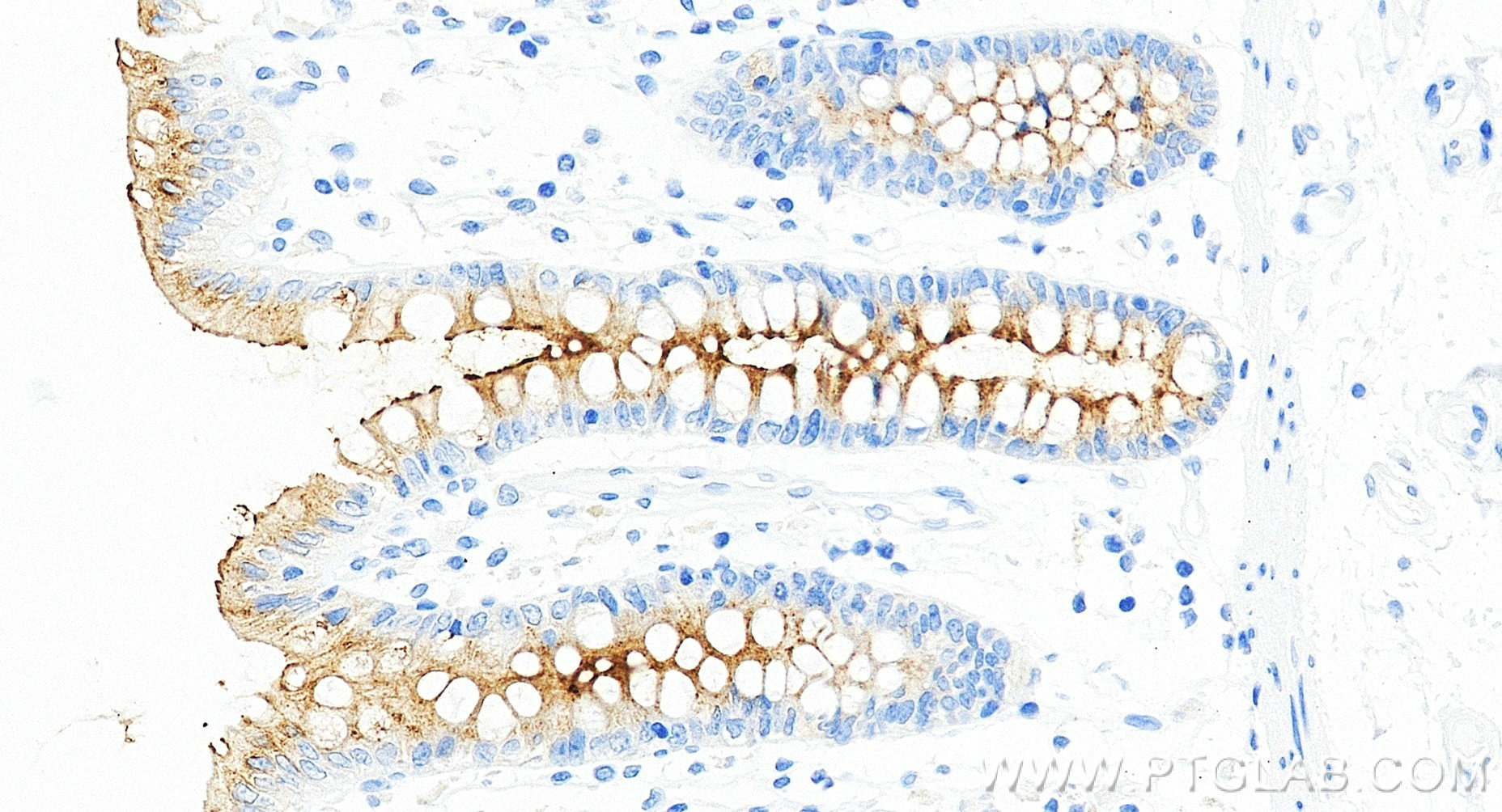 Immunohistochemical analysis of paraffin-embedded human colon tissue slide using 98683-1-RR (MUC13 antibody) at dilution of 1:1000 (under 20x lens). Heat mediated antigen retrieval with Tris-EDTA buffer (pH 9.0). Immunohistochemistry (IHC) staining of human colon tissue using Anti-Human MUC13 Rabbit Recombinant Antibody (98683-1-RR)