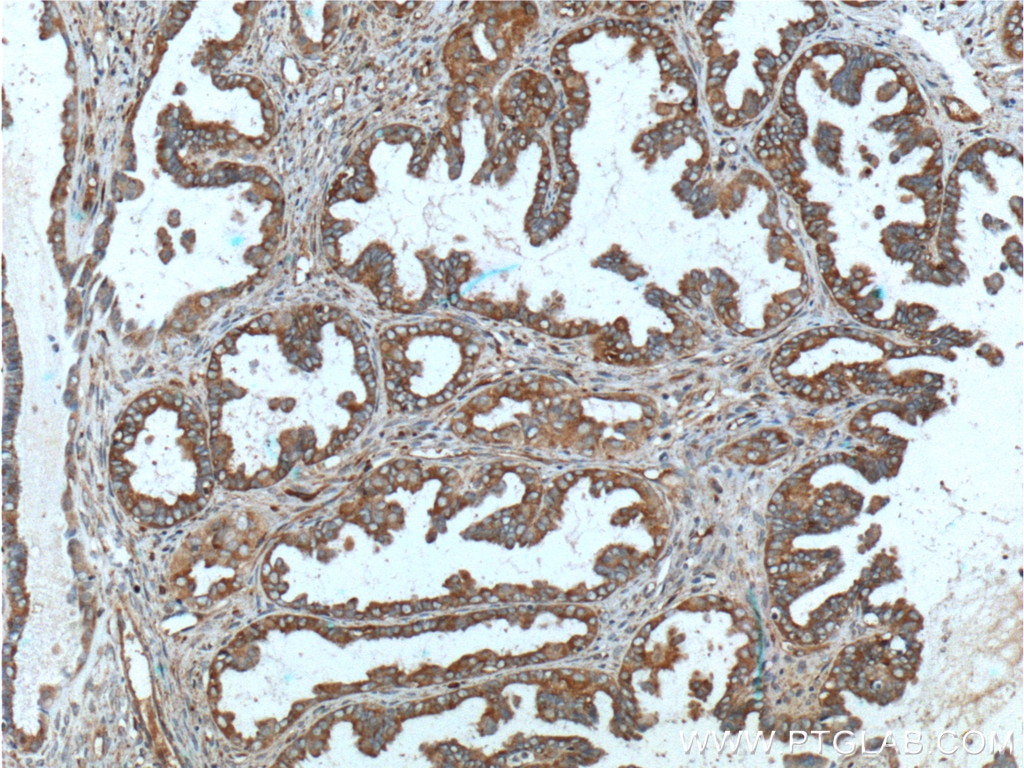 Immunohistochemistry (IHC) staining of human ovary tumor tissue using MUC16,CA125 Polyclonal antibody (20077-1-AP)
