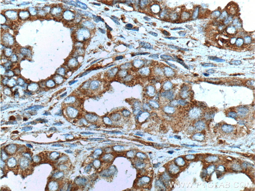 IHC staining of human ovary tumor using 20077-1-AP