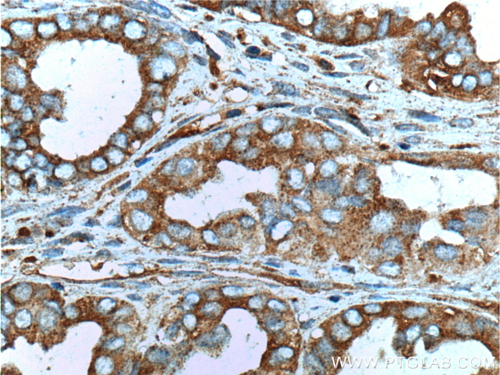 Immunohistochemistry (IHC) staining of human ovary tumor tissue using MUC16,CA125 Polyclonal antibody (20077-1-AP)