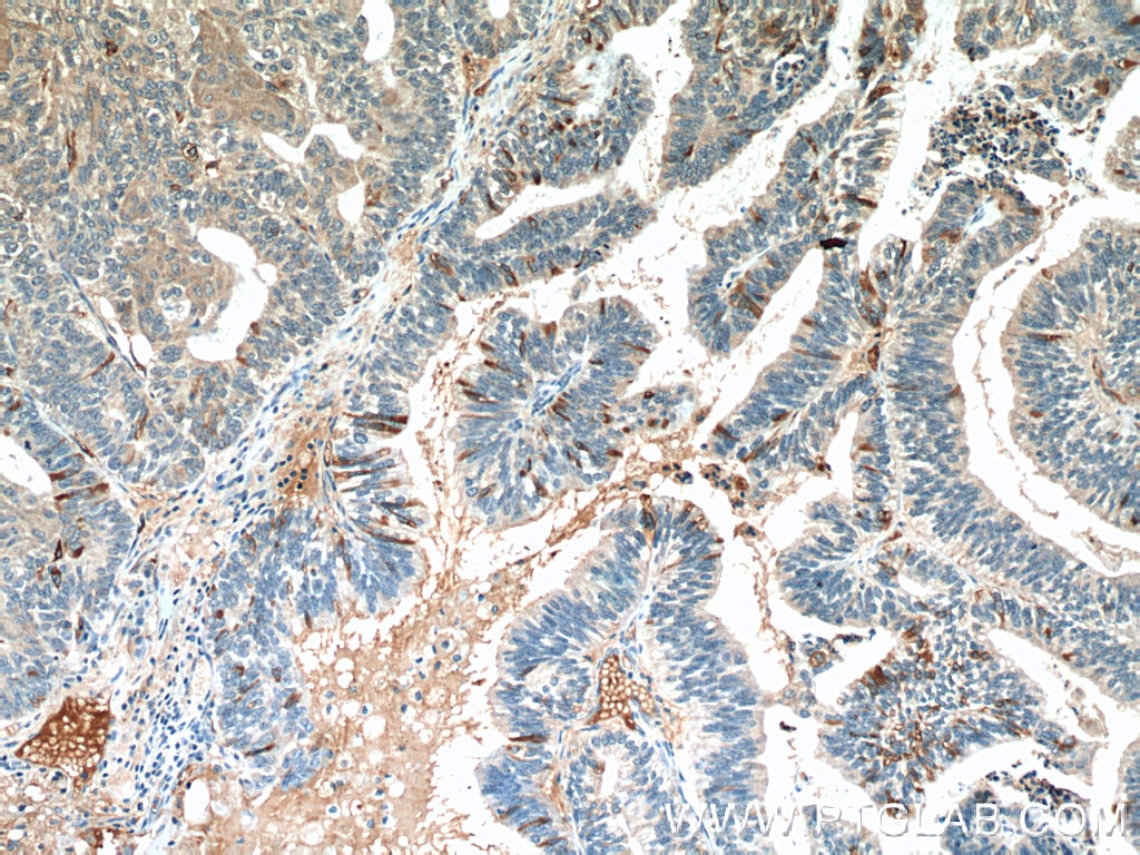 Immunohistochemistry (IHC) staining of human ovary tumor tissue using MUC16,CA125 Monoclonal antibody (60261-1-Ig)