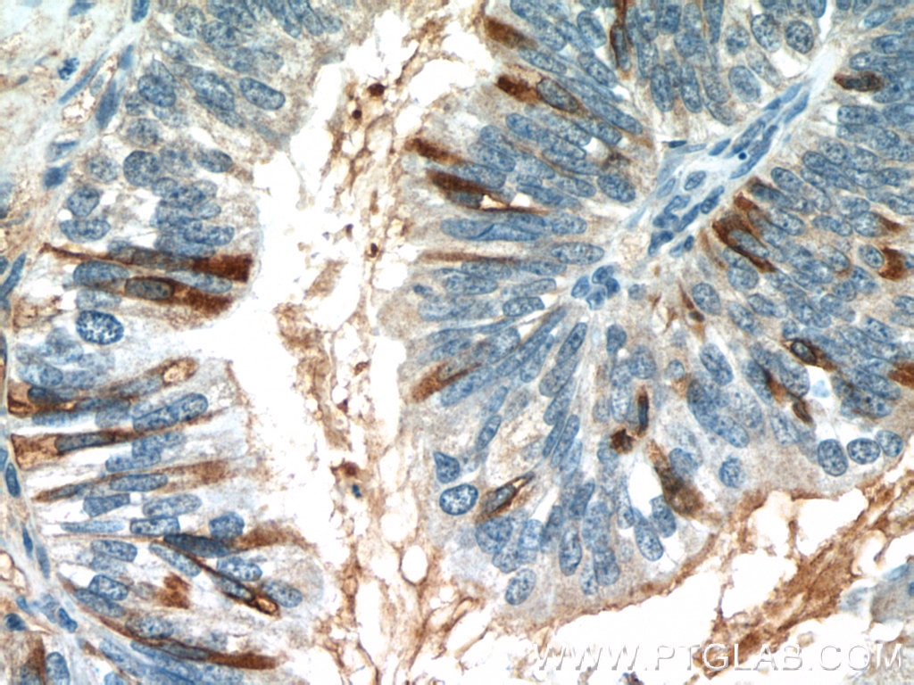 Immunohistochemistry (IHC) staining of human ovary tumor tissue using MUC16,CA125 Monoclonal antibody (60261-1-Ig)