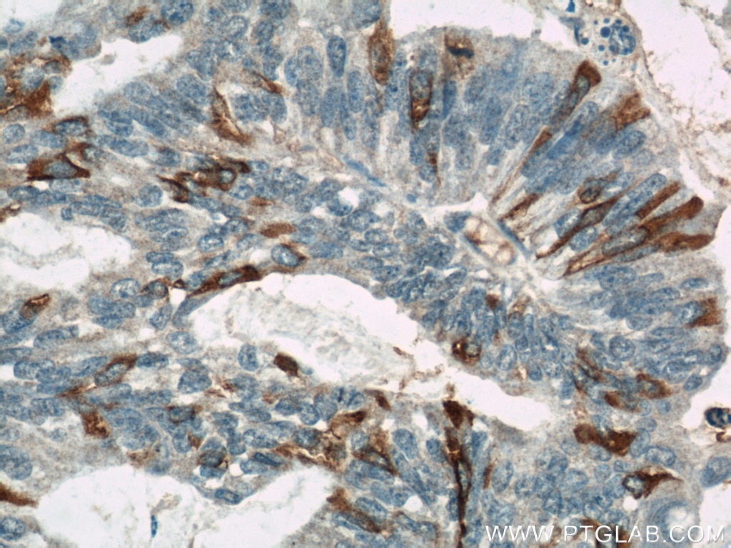 Immunohistochemistry (IHC) staining of human ovary tumor tissue using MUC16,CA125 Monoclonal antibody (60261-1-Ig)