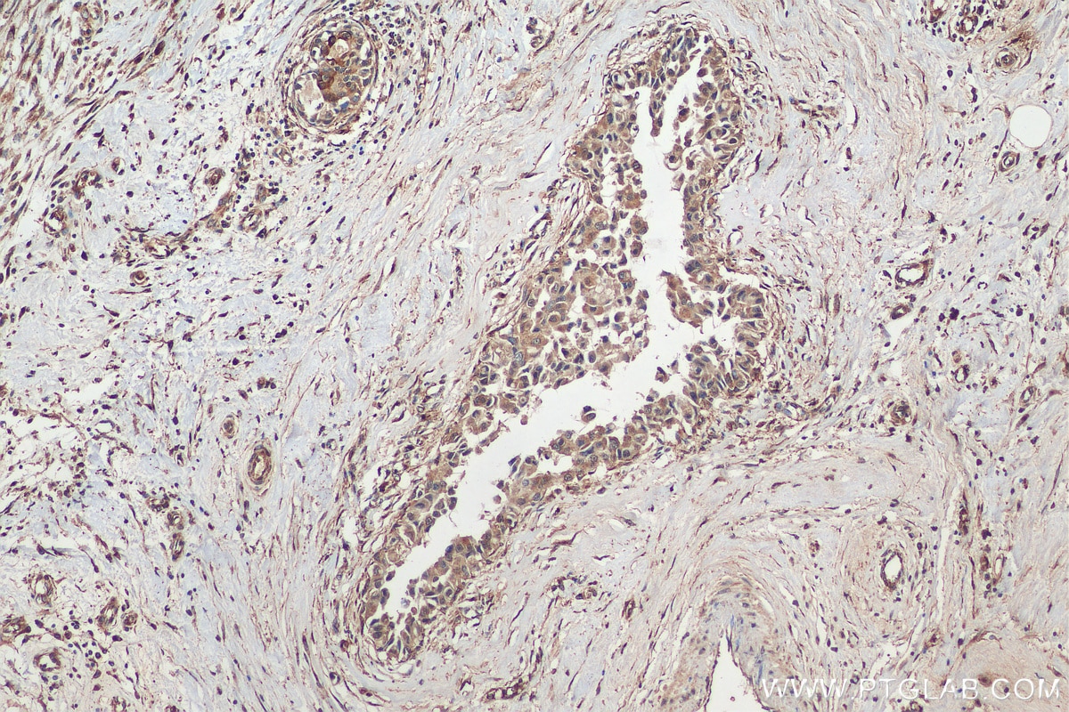 IHC staining of human breast cancer using 28703-1-AP