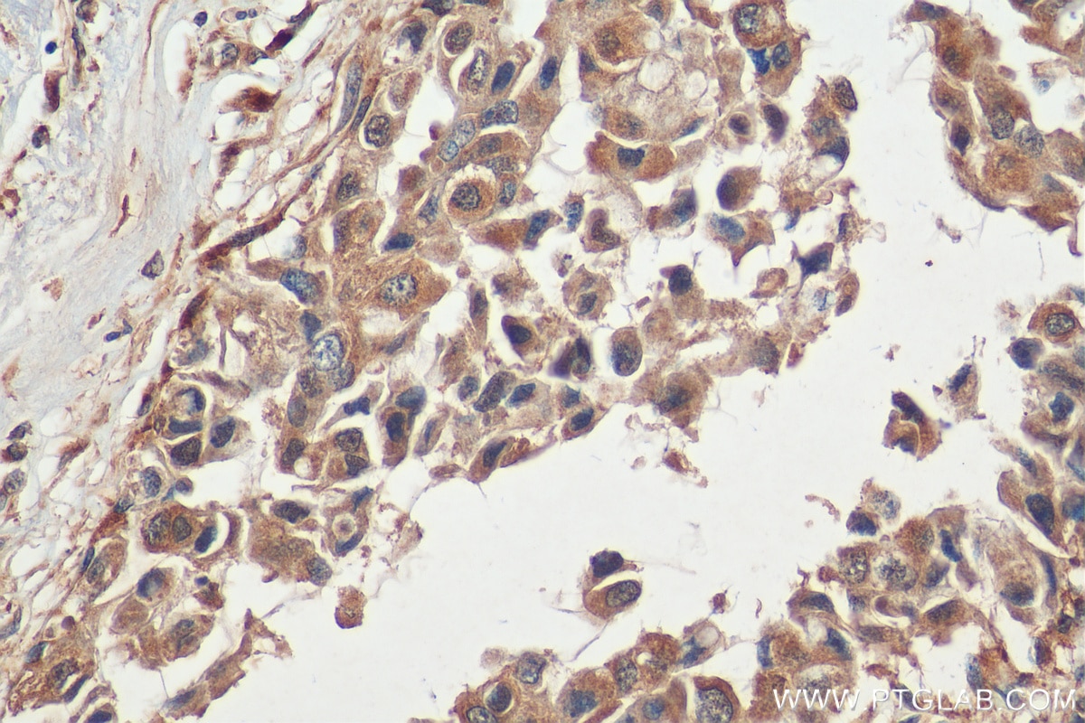 Immunohistochemistry (IHC) staining of human breast cancer tissue using MUC4 Polyclonal antibody (28703-1-AP)