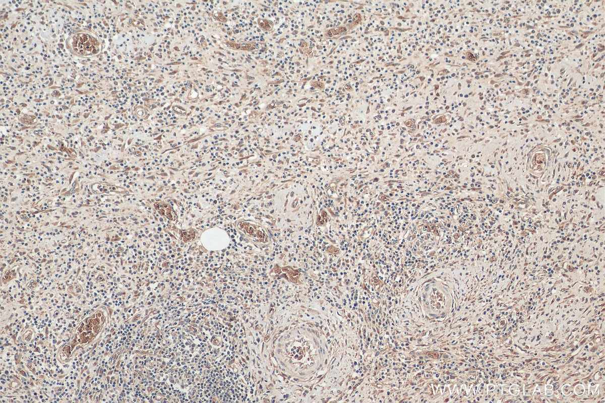 Immunohistochemistry (IHC) staining of human colon cancer tissue using MUC4 Polyclonal antibody (28703-1-AP)