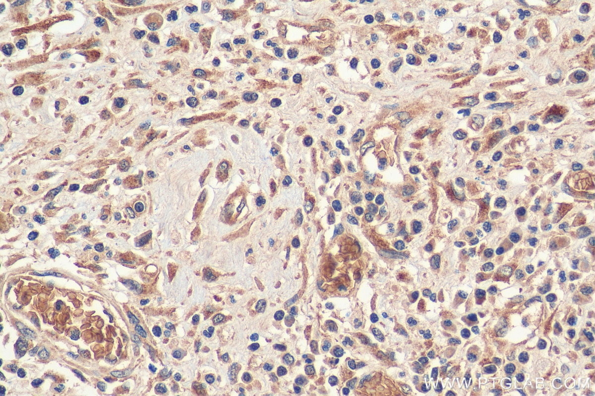 Immunohistochemistry (IHC) staining of human colon cancer tissue using MUC4 Polyclonal antibody (28703-1-AP)