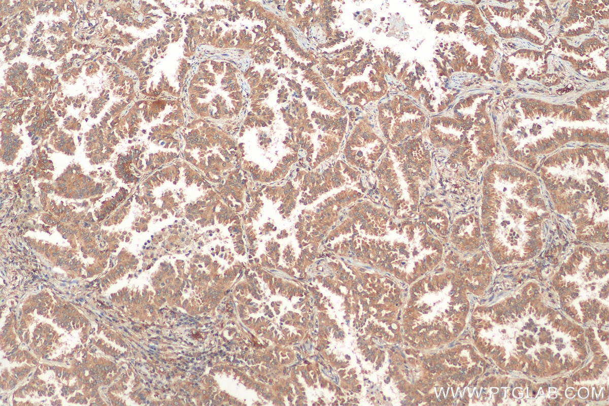 Immunohistochemistry (IHC) staining of human lung cancer tissue using MUC4 Polyclonal antibody (28703-1-AP)