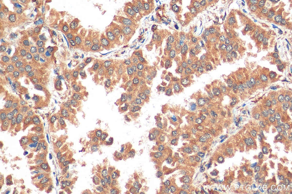 Immunohistochemistry (IHC) staining of human lung cancer tissue using MUC4 Polyclonal antibody (28703-1-AP)