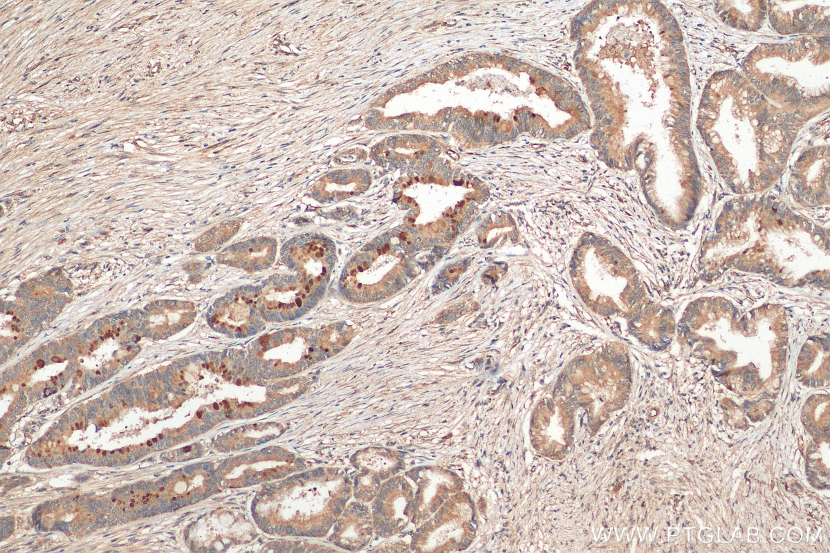 Immunohistochemistry (IHC) staining of human pancreas cancer tissue using MUC4 Polyclonal antibody (28703-1-AP)