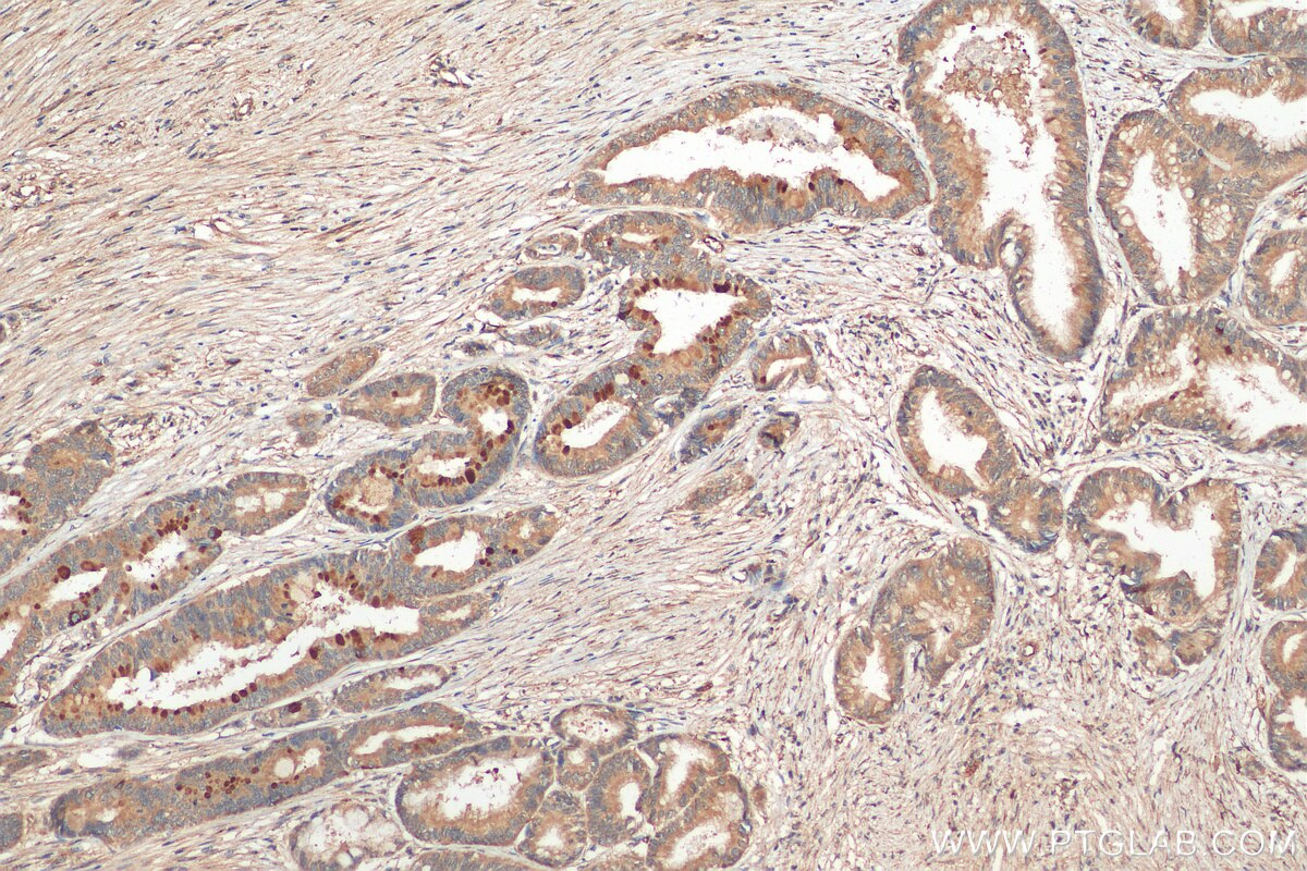 IHC staining of human pancreas cancer using 28703-1-AP