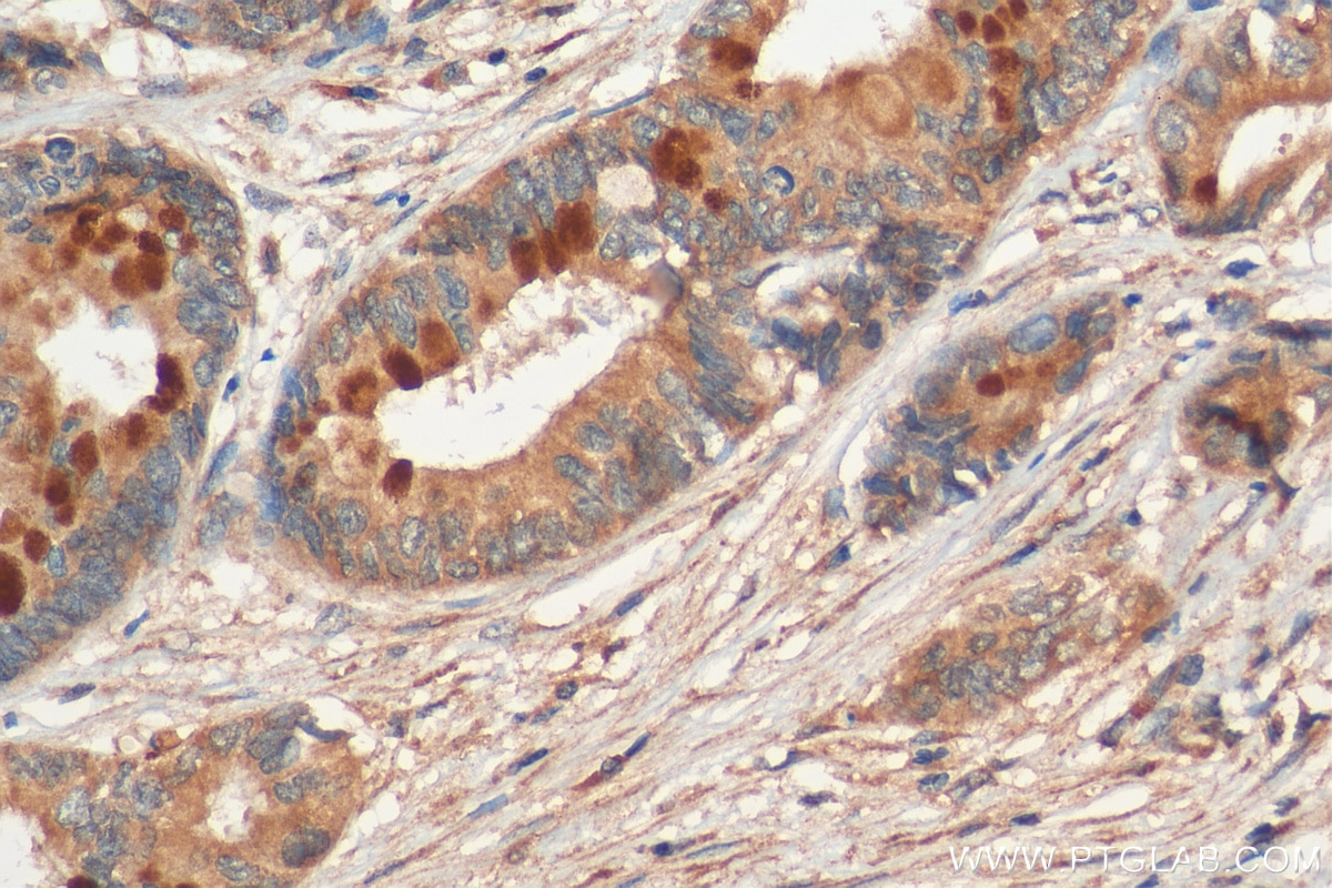 Immunohistochemistry (IHC) staining of human pancreas cancer tissue using MUC4 Polyclonal antibody (28703-1-AP)