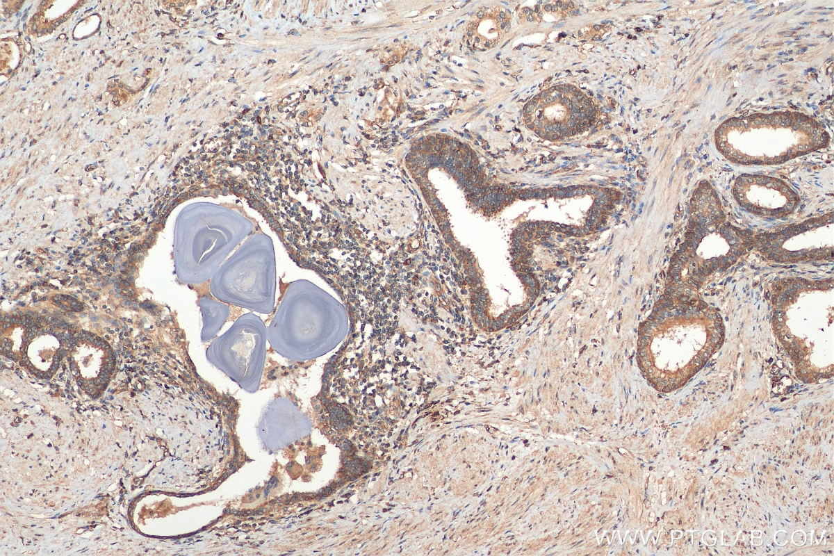 Immunohistochemistry (IHC) staining of human prostate cancer tissue using MUC4 Polyclonal antibody (28703-1-AP)