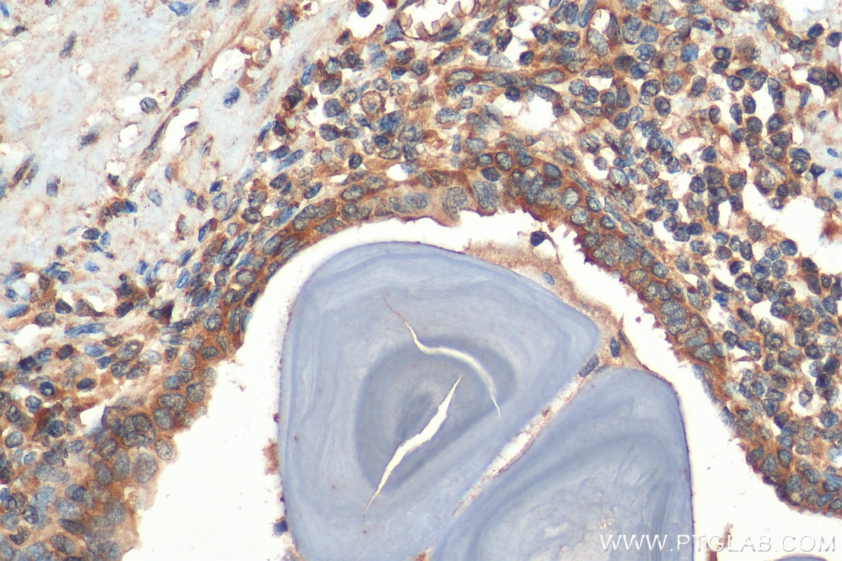 Immunohistochemistry (IHC) staining of human prostate cancer tissue using MUC4 Polyclonal antibody (28703-1-AP)