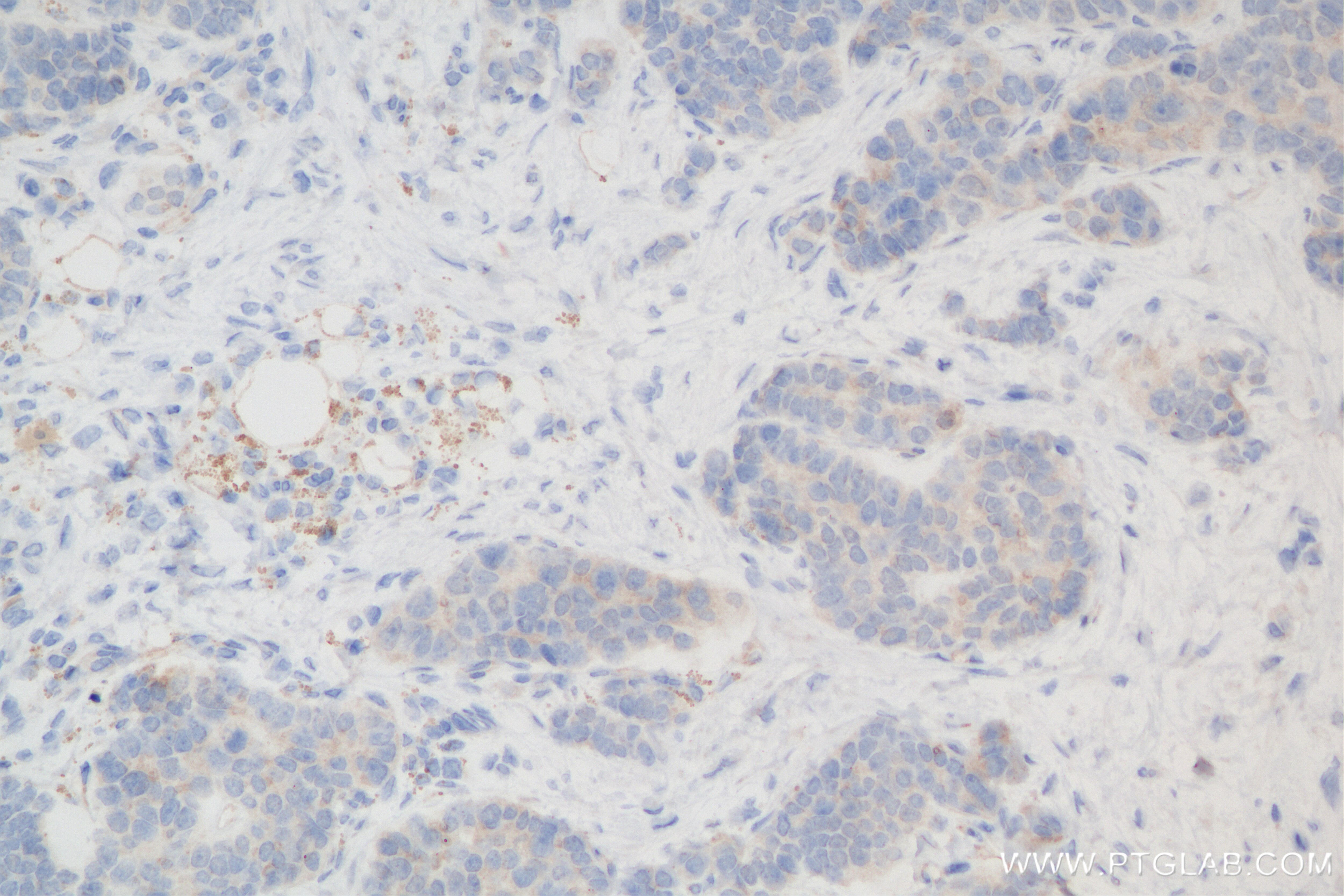 Immunohistochemical analysis of paraffin-embedded human stomach cancer tissue slide using 85868-1-RR (MUC5AC antibody) at dilution of 1:200 (under 20x lens). Heat mediated antigen retrieval with Tris-EDTA buffer (pH 9.0). Immunohistochemistry (IHC) staining of human stomach cancer tissue using MUC5AC Recombinant monoclonal antibody (85868-1-RR)