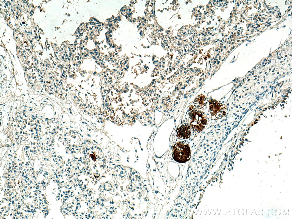 Immunohistochemistry (IHC) staining of human lung tissue using MUC5B Polyclonal antibody (28118-1-AP)