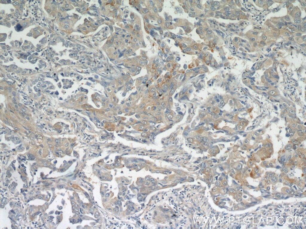 Immunohistochemistry (IHC) staining of human lung cancer tissue using MUC8 Polyclonal antibody (55489-1-AP)