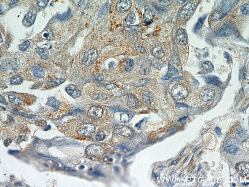 Immunohistochemistry (IHC) staining of human lung cancer tissue using MUC8 Polyclonal antibody (55489-1-AP)