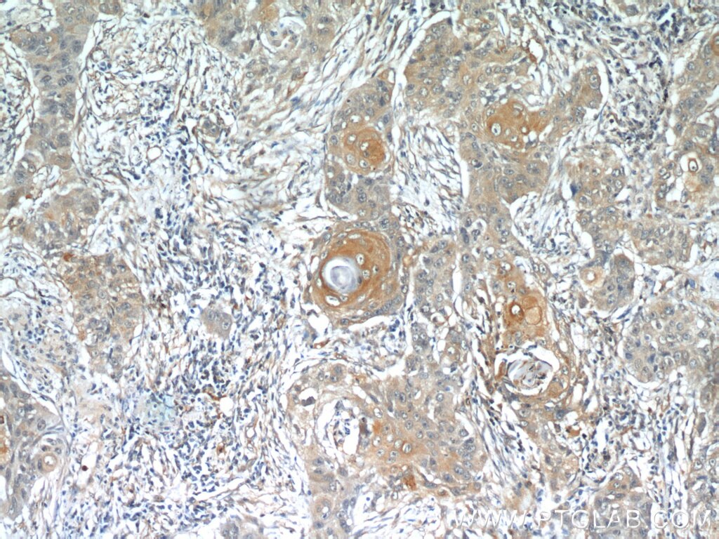 Immunohistochemistry (IHC) staining of human lung cancer tissue using MUC8 Polyclonal antibody (55489-1-AP)