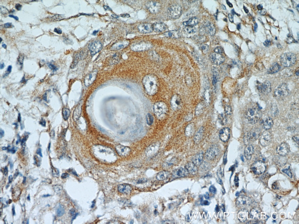 Immunohistochemistry (IHC) staining of human lung cancer tissue using MUC8 Polyclonal antibody (55489-1-AP)