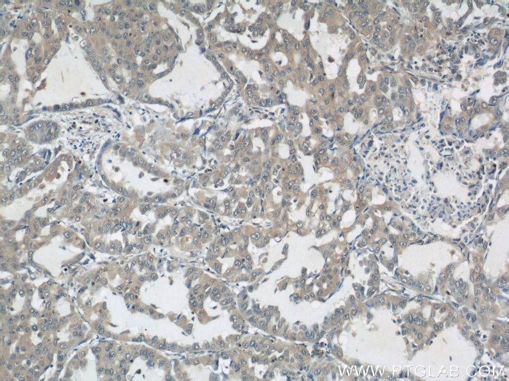 Immunohistochemistry (IHC) staining of human lung cancer tissue using MUC8 Polyclonal antibody (55489-1-AP)