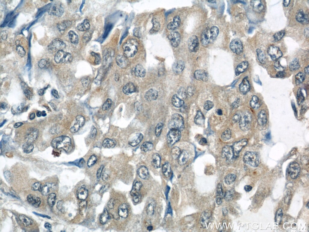 Immunohistochemistry (IHC) staining of human lung cancer tissue using MUC8 Polyclonal antibody (55489-1-AP)