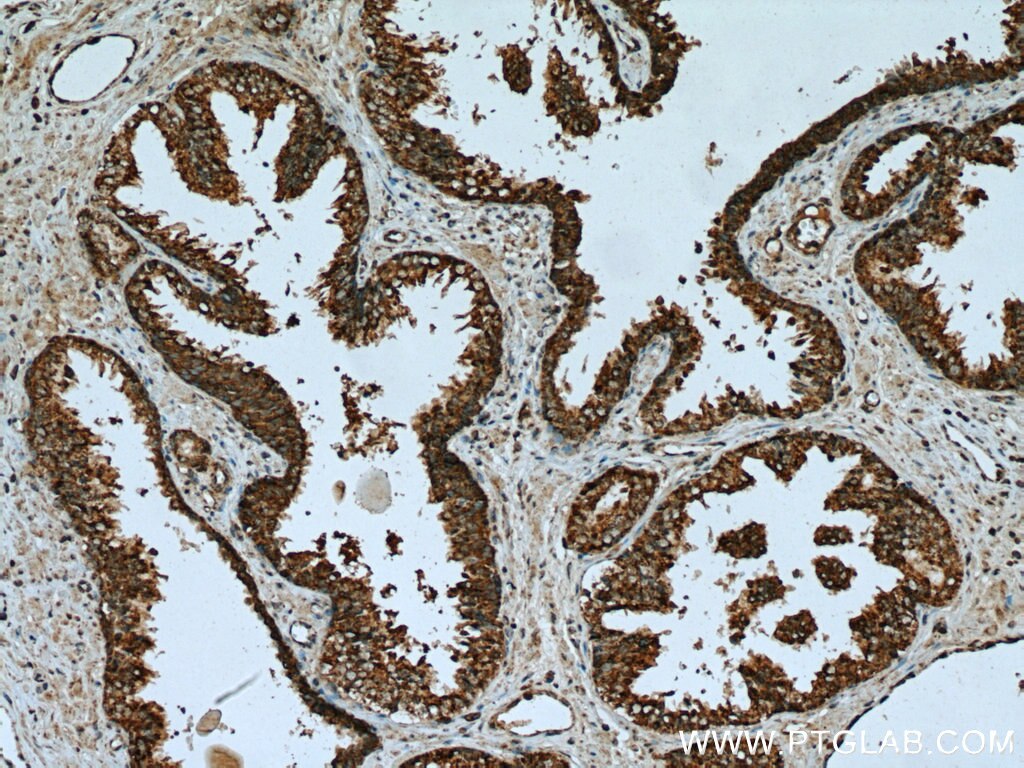 Immunohistochemistry (IHC) staining of human prostate cancer tissue using MUT Polyclonal antibody (17034-1-AP)
