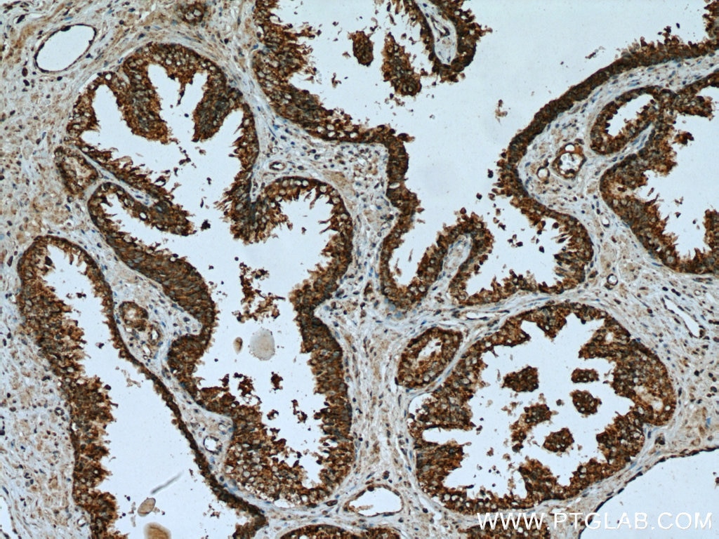 Immunohistochemistry (IHC) staining of human prostate cancer tissue using Methylmalonyl Coenzyme A mutase/MUT Polyclonal ant (17034-1-AP)