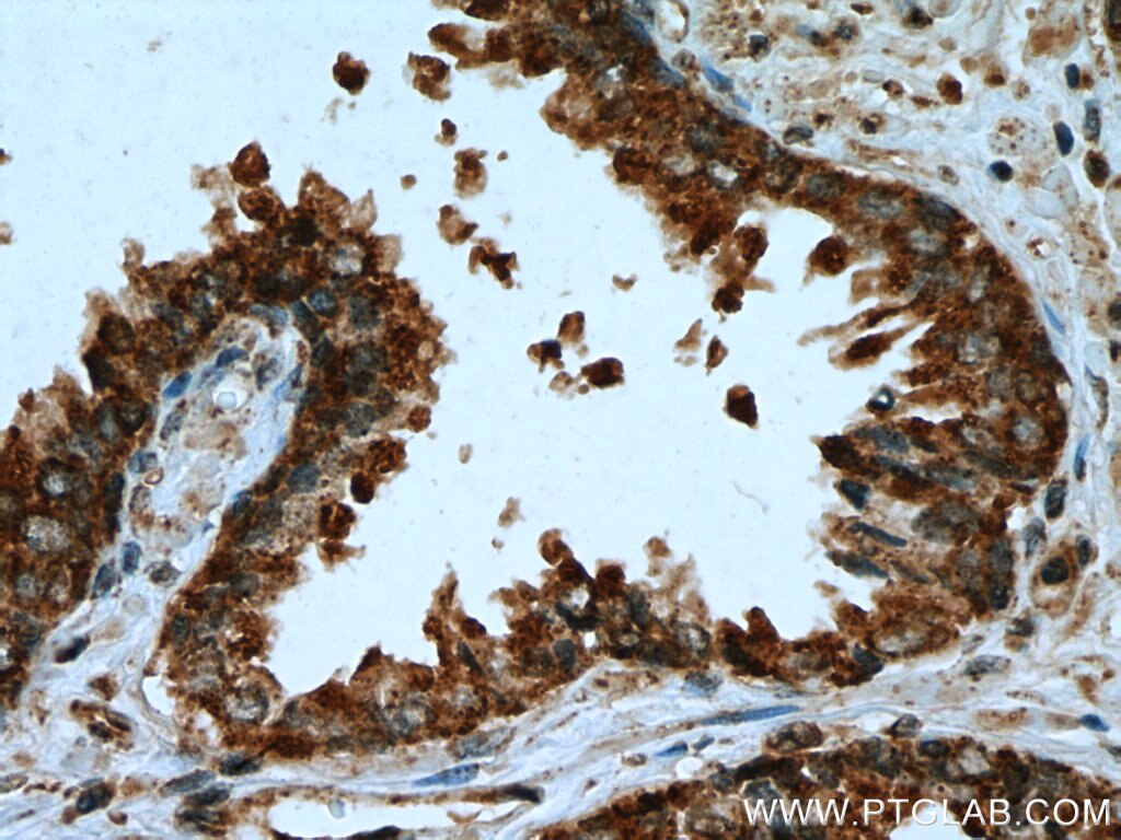 Immunohistochemistry (IHC) staining of human prostate cancer tissue using Methylmalonyl Coenzyme A mutase/MUT Polyclonal ant (17034-1-AP)