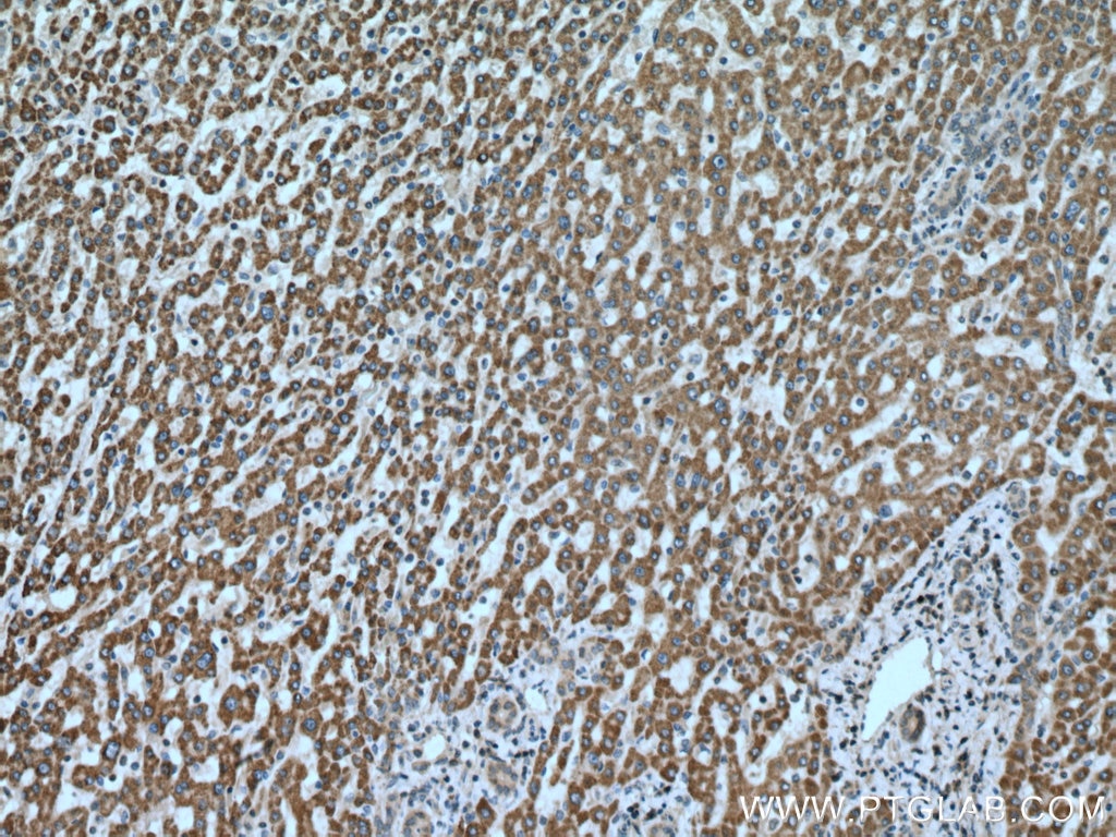 Immunohistochemistry (IHC) staining of human liver cancer tissue using Methylmalonyl Coenzyme A mutase/MUT Polyclonal ant (17034-1-AP)