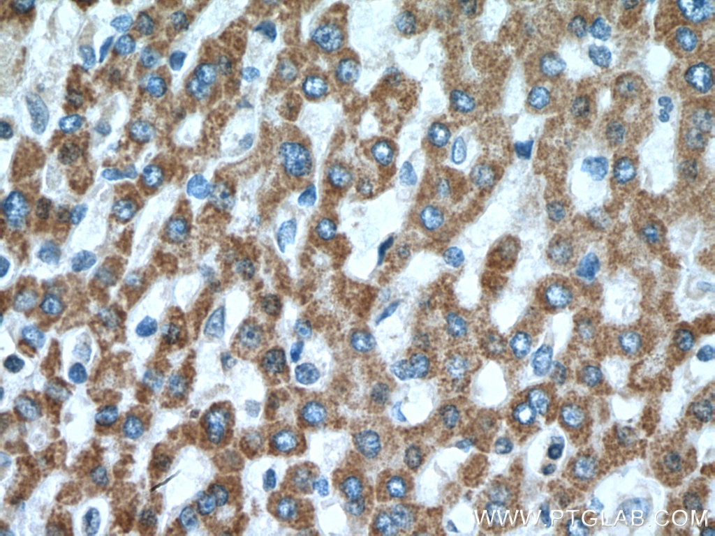 Immunohistochemistry (IHC) staining of human liver cancer tissue using MUT Polyclonal antibody (17034-1-AP)