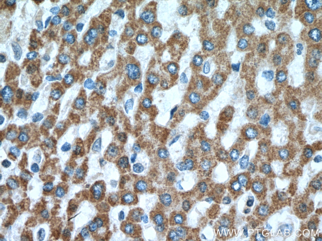 Immunohistochemistry (IHC) staining of human liver cancer tissue using Methylmalonyl Coenzyme A mutase/MUT Polyclonal ant (17034-1-AP)