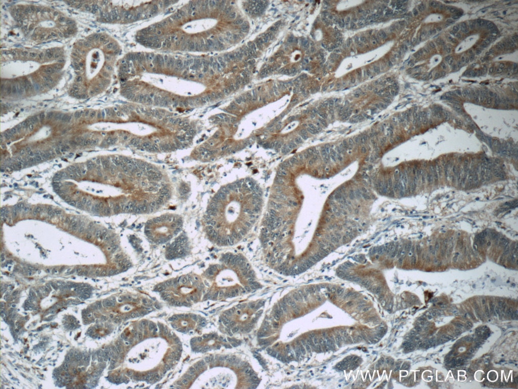 Immunohistochemistry (IHC) staining of human colon cancer tissue using MUTYH Polyclonal antibody (19650-1-AP)