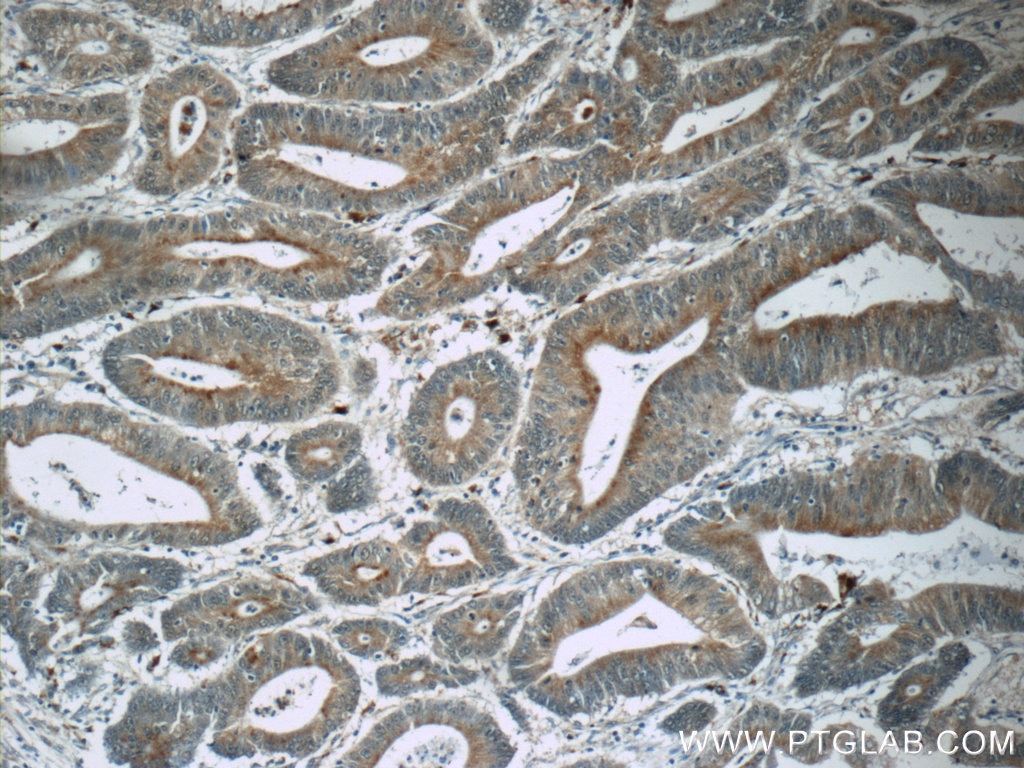 IHC staining of human colon cancer using 19650-1-AP