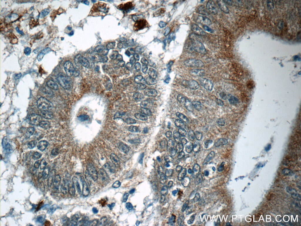 Immunohistochemistry (IHC) staining of human colon cancer tissue using MUTYH Polyclonal antibody (19650-1-AP)