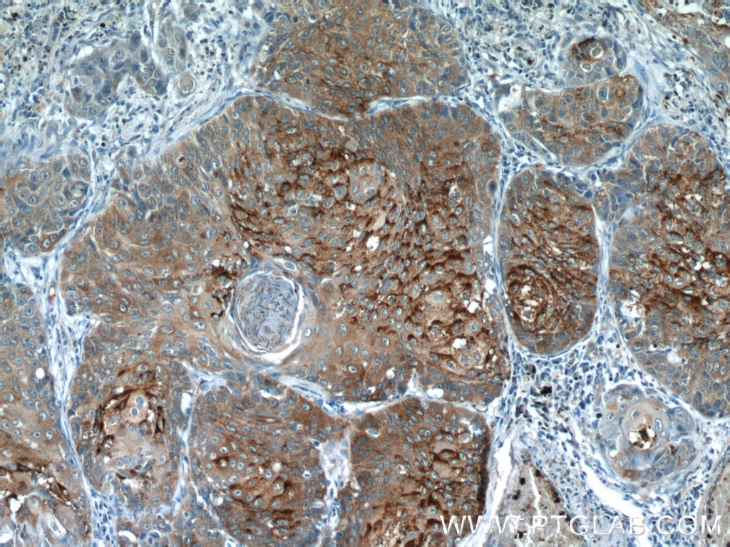 Immunohistochemistry (IHC) staining of human lung cancer tissue using MVD Polyclonal antibody (15331-1-AP)