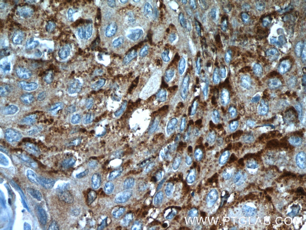 Immunohistochemistry (IHC) staining of human lung cancer tissue using MVD Polyclonal antibody (15331-1-AP)