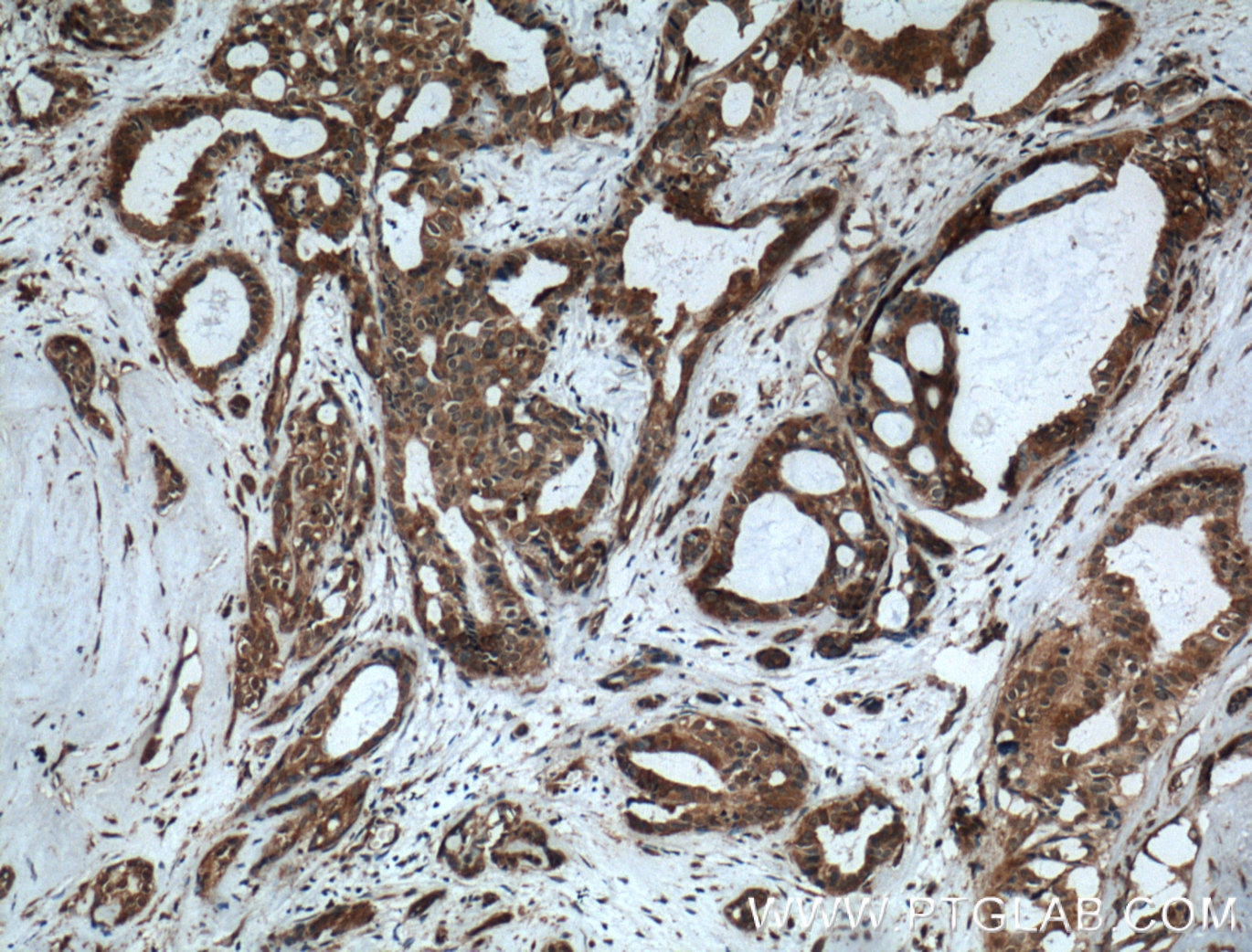 Immunohistochemistry (IHC) staining of human breast cancer tissue using MVP/LRP Polyclonal antibody (16478-1-AP)
