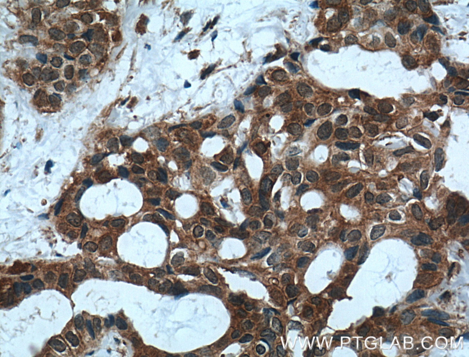 Immunohistochemistry (IHC) staining of human breast cancer tissue using MVP/LRP Polyclonal antibody (16478-1-AP)