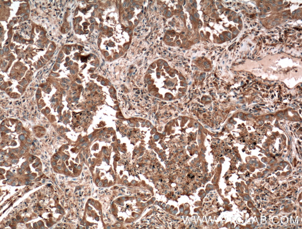 Immunohistochemistry (IHC) staining of human lung cancer tissue using MVP/LRP Polyclonal antibody (16478-1-AP)