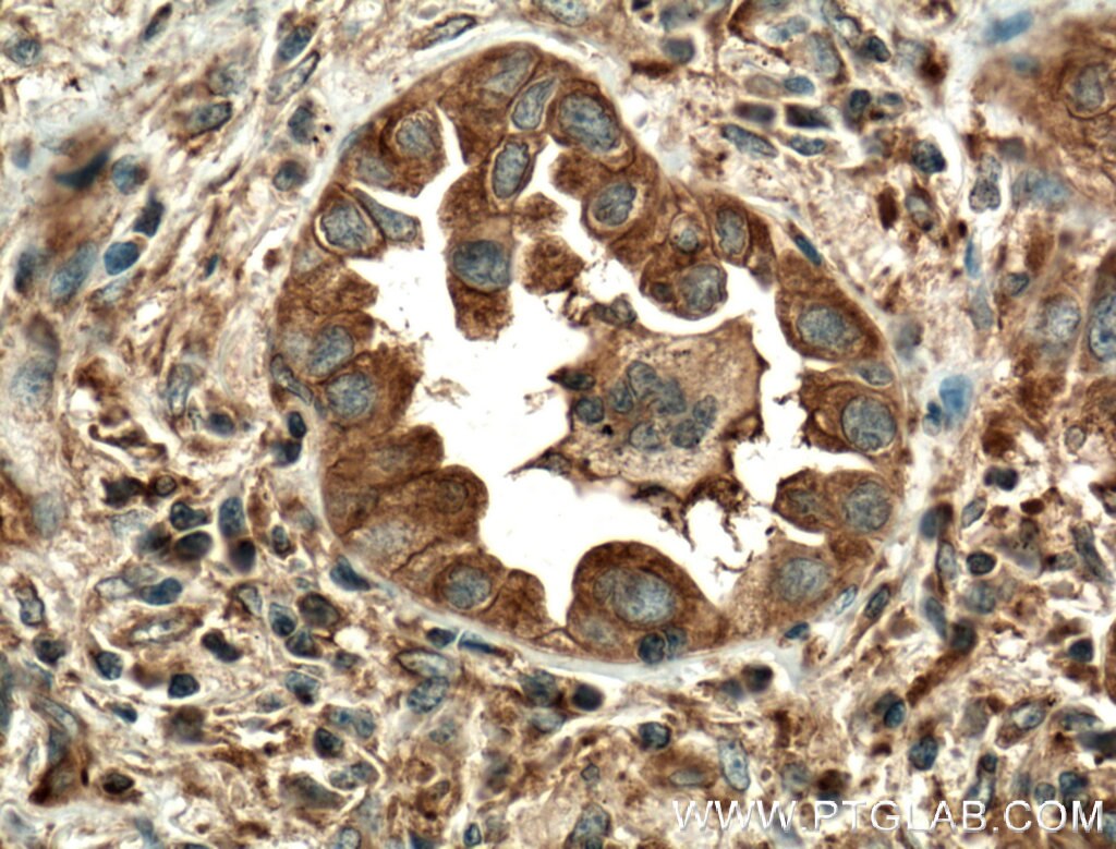 IHC staining of human lung cancer using 16478-1-AP